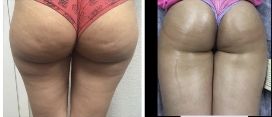Before and after Non-Invasive BBL at Perfections Body Sculpt, Rowlett TX