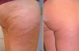 Before and after Non-Invasive BBL at Perfections Body Sculpt, Rowlett TX