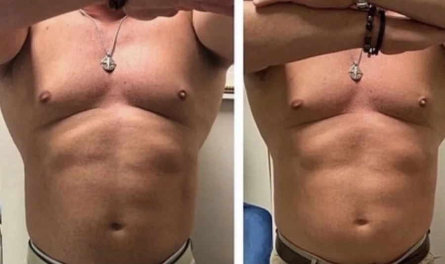 Before and after EMS with RF at Perfections Body Sculpt, Rowlett TX