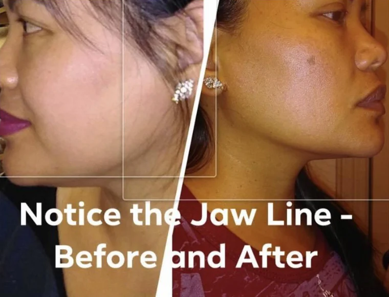 Before and after Red Carpet RF Facial · Jawline at Perfections Body Sculpt, Rowlett TX