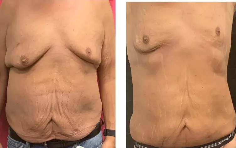 Before and after Laser Lipo at Perfections Body Sculpt, Rowlett TX