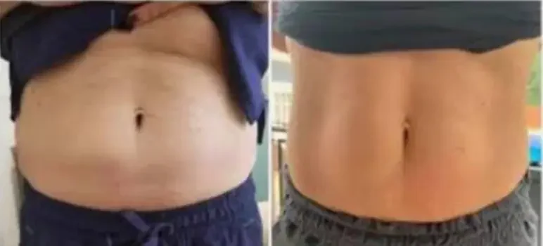Before and after Laser Lipo at Perfections Body Sculpt, Rowlett TX