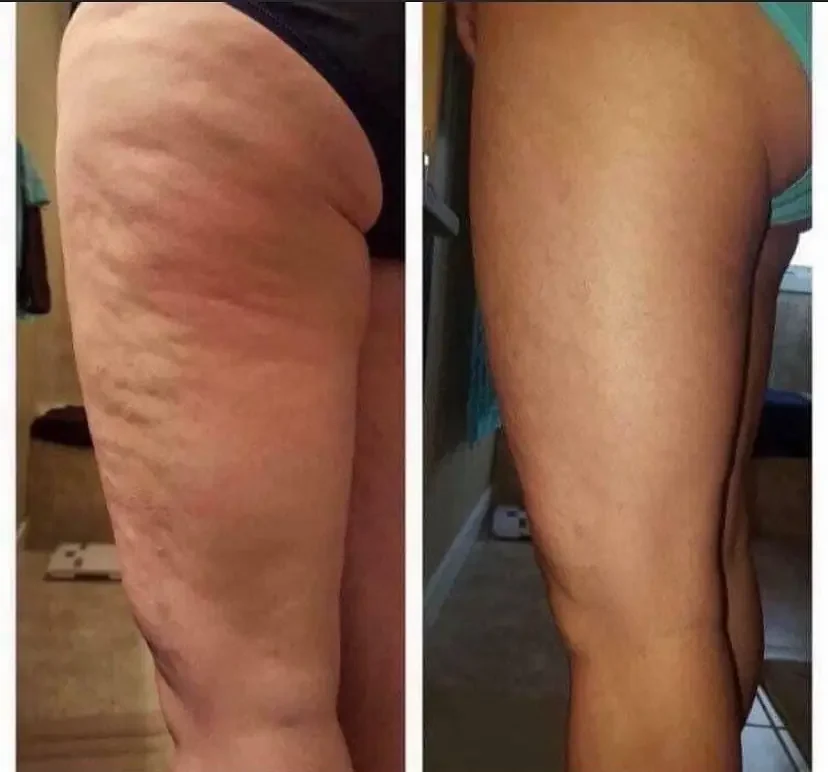 Before and after Laser Lipo · Legs at Perfections Body Sculpt, Rowlett TX