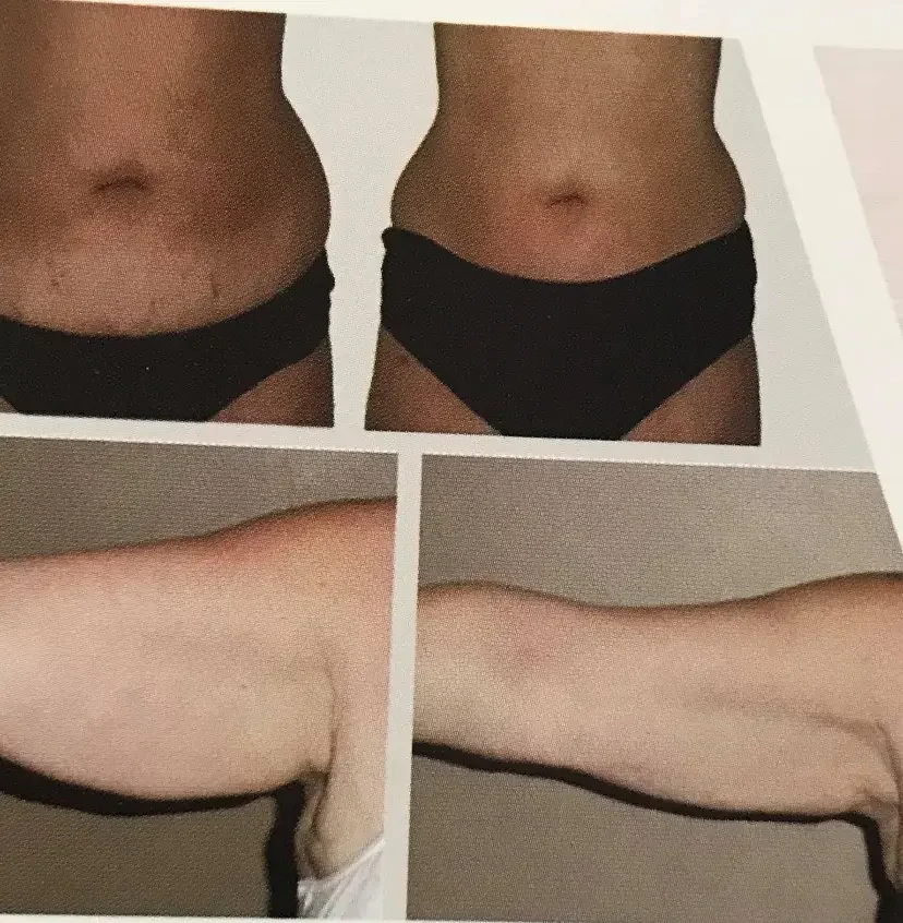 Before and after Laser Lipo · Arms at Perfections Body Sculpt, Rowlett TX