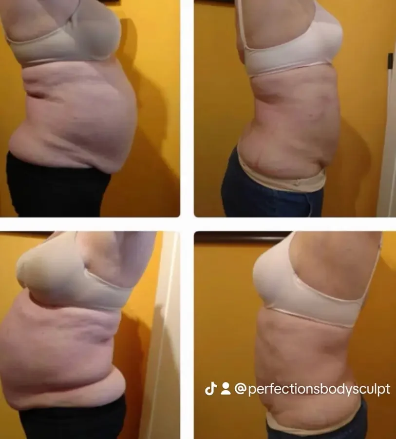 Before and after Laser Lipo at Perfections Body Sculpt, Rowlett TX